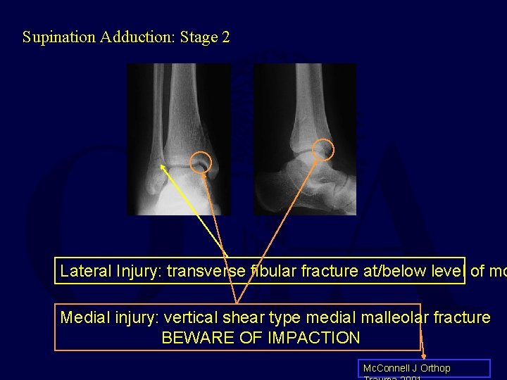 Supination Adduction: Stage 2 Lateral Injury: transverse fibular fracture at/below level of mo Medial