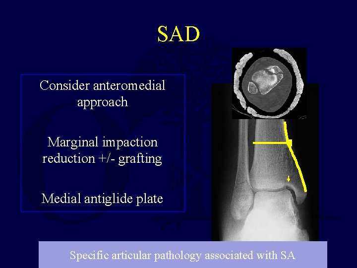 SAD Consider anteromedial approach Marginal impaction reduction +/- grafting Medial antiglide plate Specific articular SAD Consider anteromedial approach Marginal impaction reduction +/- grafting Medial antiglide plate Specific articular