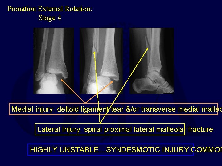 Pronation External Rotation: Stage 4 Medial injury: deltoid ligament tear &/or transverse medial malleo