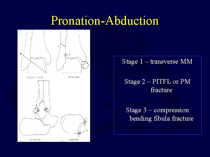 Pronation-Abduction Stage 1 – transverse MM Stage 2 – PITFL or PM fracture Stage