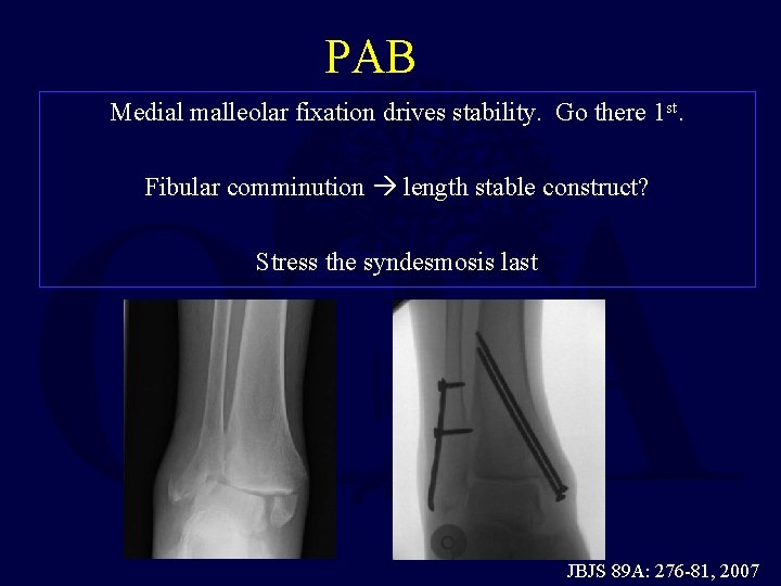 PAB Medial malleolar fixation drives stability. Go there 1 st. Fibular comminution length stable PAB Medial malleolar fixation drives stability. Go there 1 st. Fibular comminution length stable