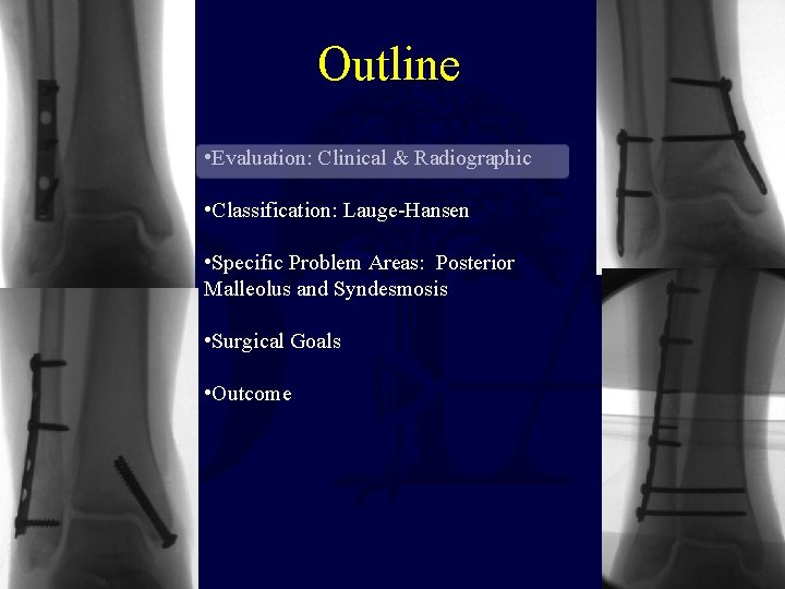 Outline • Evaluation: Clinical & Radiographic • Classification: Lauge-Hansen • Specific Problem Areas: Posterior