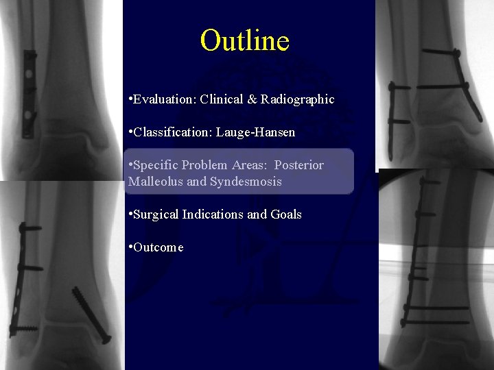 Outline • Evaluation: Clinical & Radiographic • Classification: Lauge-Hansen • Specific Problem Areas: Posterior