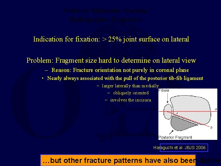 Posterior Malleolus Fracture: Radiographic Evaluation Indication for fixation: > 25% joint surface on lateral