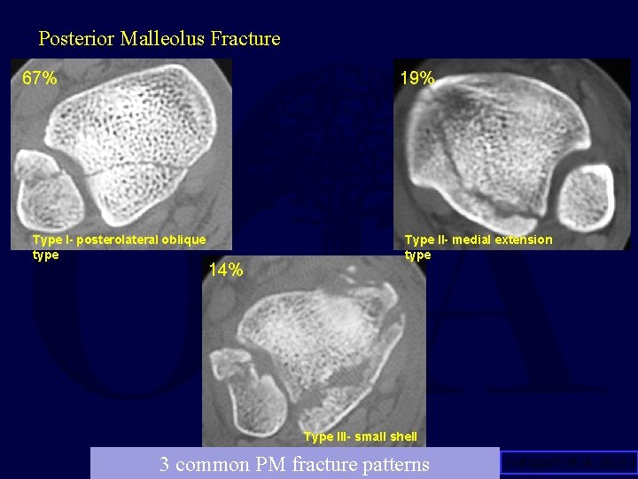 Posterior Malleolus Fracture 67% 19% Type I- posterolateral oblique type 14% Type II- medial