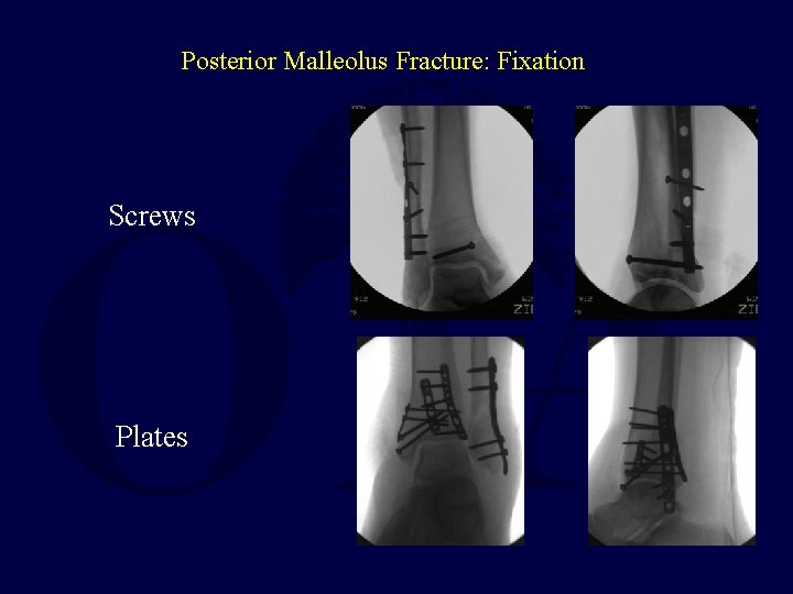 Posterior Malleolus Fracture: Fixation Screws Plates 