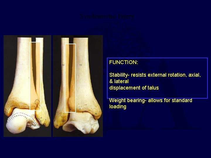 Syndesmotic Injury FUNCTION: Stability- resists external rotation, axial, & lateral displacement of talus Weight