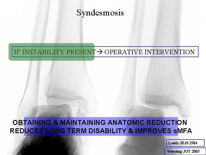 Syndesmosis IF INSTABILITY PRESENT OPERATIVE INTERVENTION OBTAINING & MAINTAINING ANATOMIC REDUCTION REDUCES LONG TERM Syndesmosis IF INSTABILITY PRESENT OPERATIVE INTERVENTION OBTAINING & MAINTAINING ANATOMIC REDUCTION REDUCES LONG TERM