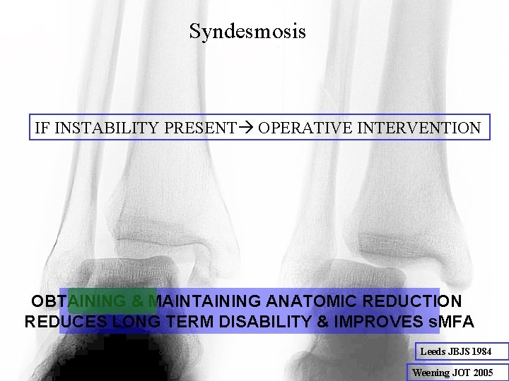 Syndesmosis IF INSTABILITY PRESENT OPERATIVE INTERVENTION OBTAINING & MAINTAINING ANATOMIC REDUCTION REDUCES LONG TERM