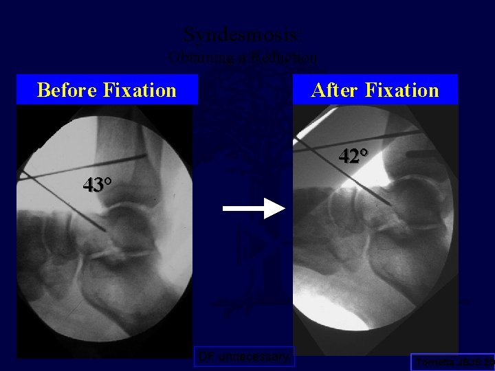 Syndesmosis: Obtaining a Reduction Before Fixation After Fixation 42° 43 DF unnecessary Tornetta JBJS