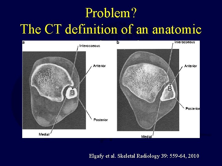 Problem? The CT definition of an anatomic syndesmosis Elgafy et al. Skeletal Radiology 39: