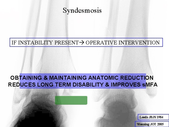 Syndesmosis IF INSTABILITY PRESENT OPERATIVE INTERVENTION OBTAINING & MAINTAINING ANATOMIC REDUCTION REDUCES LONG TERM