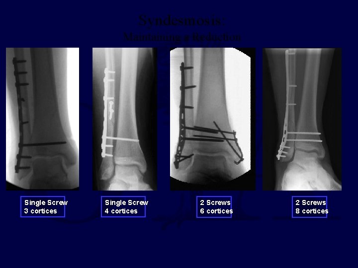 Syndesmosis: Maintaining a Reduction Single Screw 3 cortices Single Screw 4 cortices 2 Screws Syndesmosis: Maintaining a Reduction Single Screw 3 cortices Single Screw 4 cortices 2 Screws