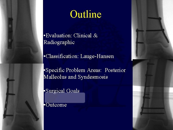 Outline • Evaluation: Clinical & Radiographic • Classification: Lauge-Hansen • Specific Problem Areas: Posterior