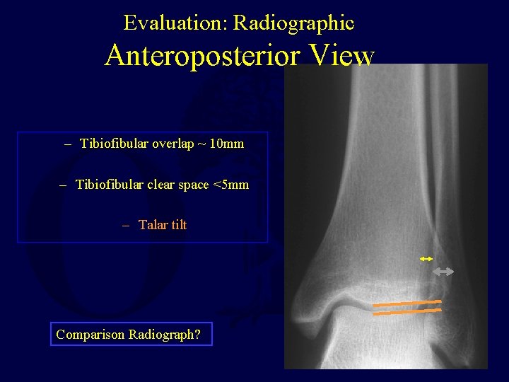 Evaluation: Radiographic Anteroposterior View – Tibiofibular overlap ~ 10 mm – Tibiofibular clear space