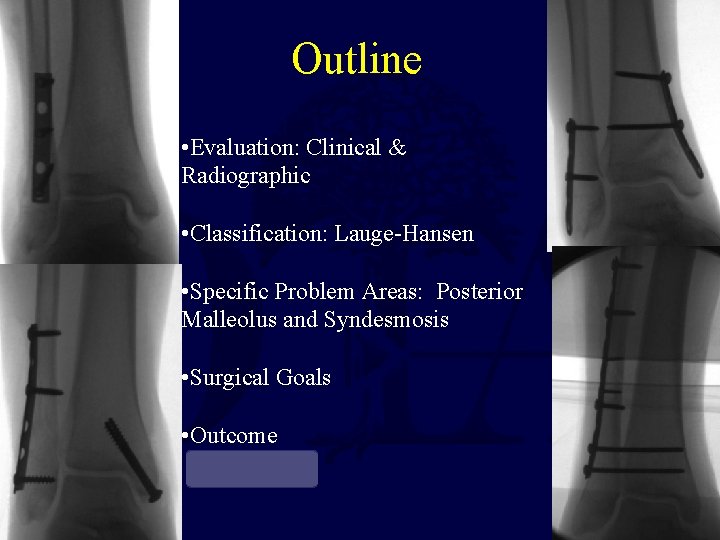 Outline • Evaluation: Clinical & Radiographic • Classification: Lauge-Hansen • Specific Problem Areas: Posterior Outline • Evaluation: Clinical & Radiographic • Classification: Lauge-Hansen • Specific Problem Areas: Posterior