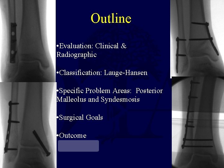 Outline • Evaluation: Clinical & Radiographic • Classification: Lauge-Hansen • Specific Problem Areas: Posterior