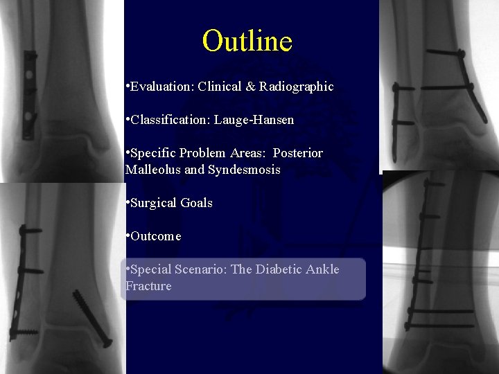 Outline • Evaluation: Clinical & Radiographic • Classification: Lauge-Hansen • Specific Problem Areas: Posterior Outline • Evaluation: Clinical & Radiographic • Classification: Lauge-Hansen • Specific Problem Areas: Posterior