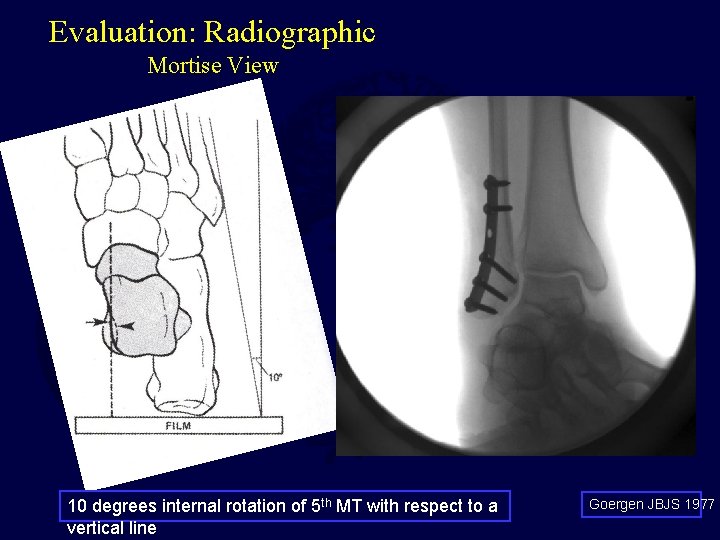 Evaluation: Radiographic Mortise View 10 degrees internal rotation of 5 th MT with respect Evaluation: Radiographic Mortise View 10 degrees internal rotation of 5 th MT with respect