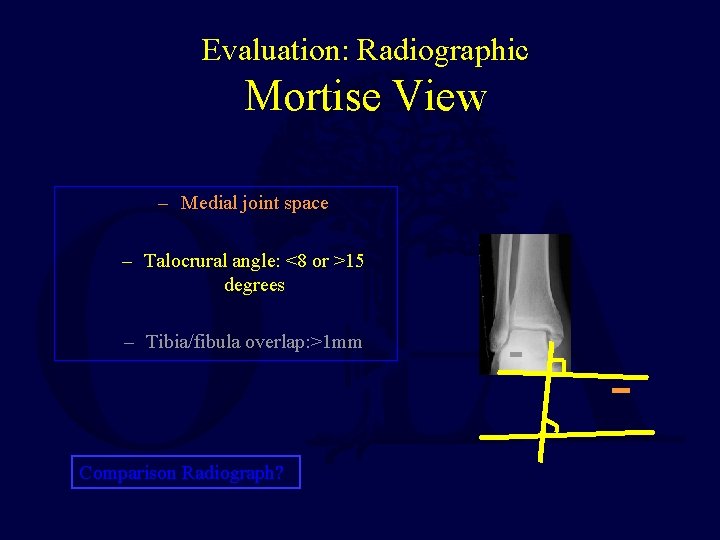 Evaluation: Radiographic Mortise View – Medial joint space – Talocrural angle: <8 or >15 Evaluation: Radiographic Mortise View – Medial joint space – Talocrural angle: <8 or >15