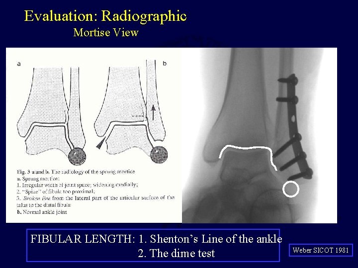 Evaluation: Radiographic Mortise View FIBULAR LENGTH: 1. Shenton’s Line of the ankle 2. The Evaluation: Radiographic Mortise View FIBULAR LENGTH: 1. Shenton’s Line of the ankle 2. The