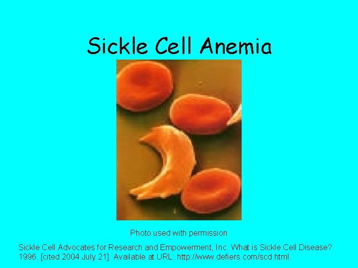 Sickle Cell Anemia Photo used with permission Sickle Cell Advocates for Research and Empowerment,