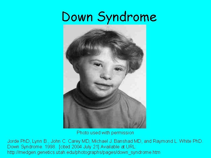 Down Syndrome Photo used with permission Jorde Ph. D, Lynn B. , John C.