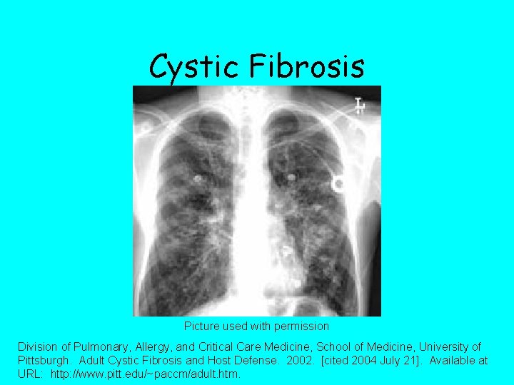 Cystic Fibrosis Picture used with permission Division of Pulmonary, Allergy, and Critical Care Medicine,