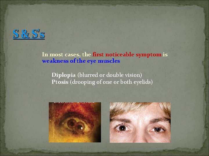 S & S's In most cases, the first noticeable symptom is weakness of the