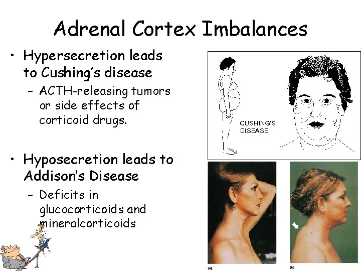 Adrenal Cortex Imbalances • Hypersecretion leads to Cushing’s disease – ACTH-releasing tumors or side