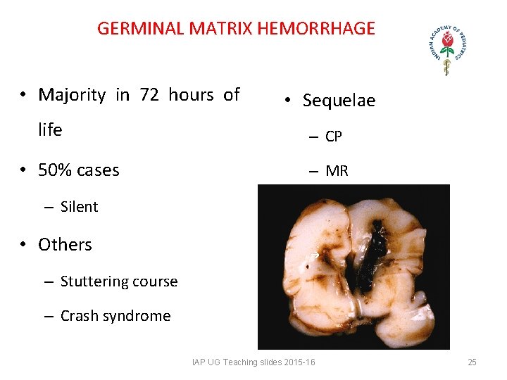 GERMINAL MATRIX HEMORRHAGE • Majority in 72 hours of life • 50% cases GERMINAL MATRIX HEMORRHAGE • Majority in 72 hours of life • 50% cases