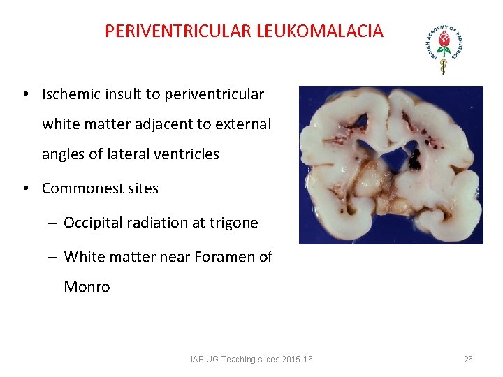 PERIVENTRICULAR LEUKOMALACIA • Ischemic insult to periventricular white matter adjacent to external angles of PERIVENTRICULAR LEUKOMALACIA • Ischemic insult to periventricular white matter adjacent to external angles of