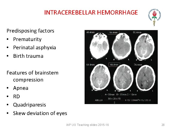 INTRACEREBELLAR HEMORRHAGE Predisposing factors • Prematurity • Perinatal asphyxia • Birth trauma Features INTRACEREBELLAR HEMORRHAGE Predisposing factors • Prematurity • Perinatal asphyxia • Birth trauma Features