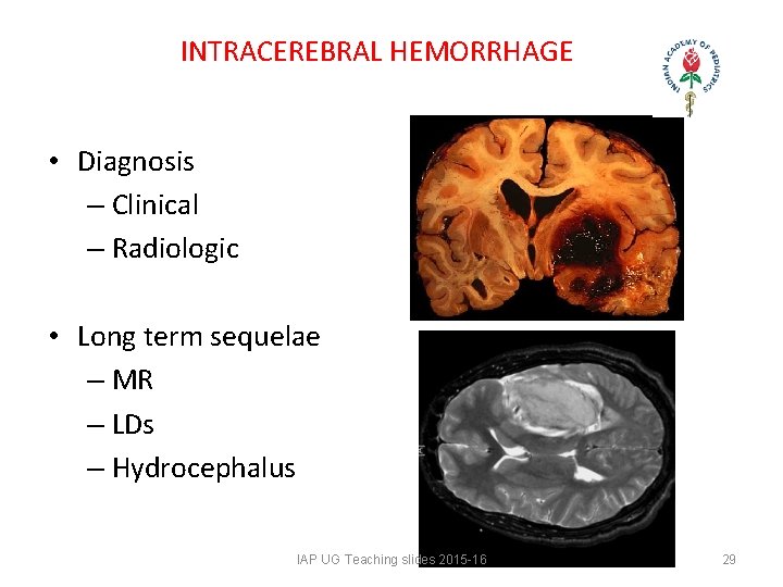 INTRACEREBRAL HEMORRHAGE • Diagnosis – Clinical – Radiologic • Long term sequelae – INTRACEREBRAL HEMORRHAGE • Diagnosis – Clinical – Radiologic • Long term sequelae –