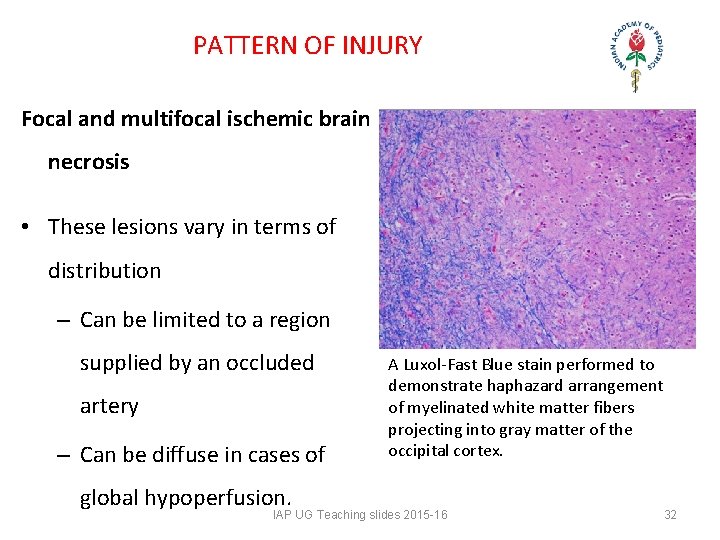 PATTERN OF INJURY Focal and multifocal ischemic brain necrosis • These lesions vary PATTERN OF INJURY Focal and multifocal ischemic brain necrosis • These lesions vary