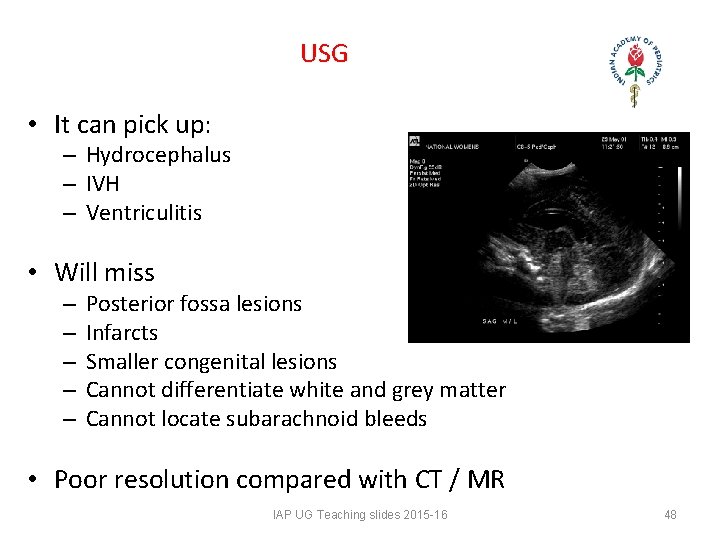 USG • It can pick up: – Hydrocephalus – IVH – Ventriculitis • Will USG • It can pick up: – Hydrocephalus – IVH – Ventriculitis • Will