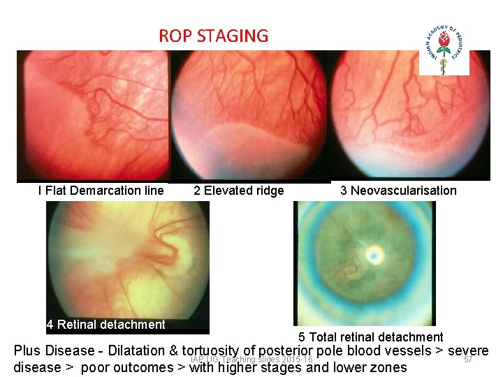 ROP STAGING I Flat Demarcation line 4 Retinal detachment 2 Elevated ridge 3 Neovascularisation ROP STAGING I Flat Demarcation line 4 Retinal detachment 2 Elevated ridge 3 Neovascularisation