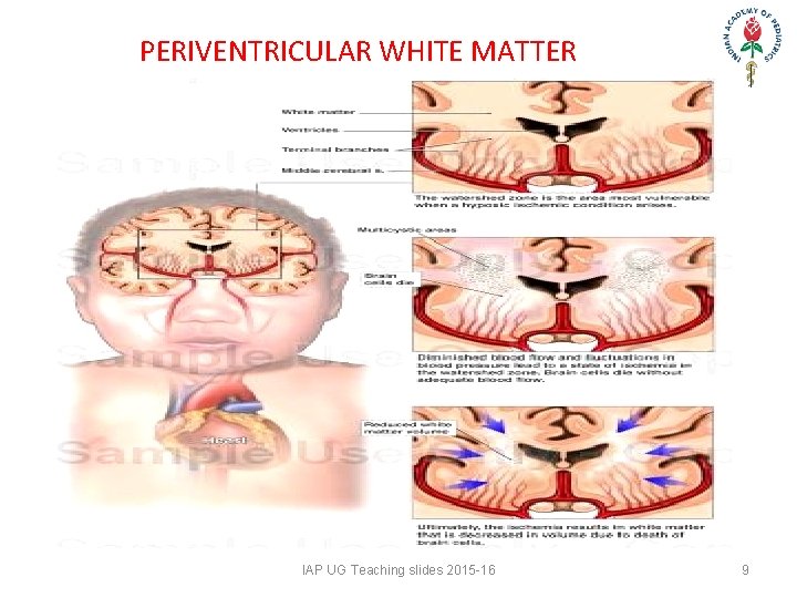 PERIVENTRICULAR WHITE MATTER IAP UG Teaching slides 2015 -16 9 PERIVENTRICULAR WHITE MATTER IAP UG Teaching slides 2015 -16 9