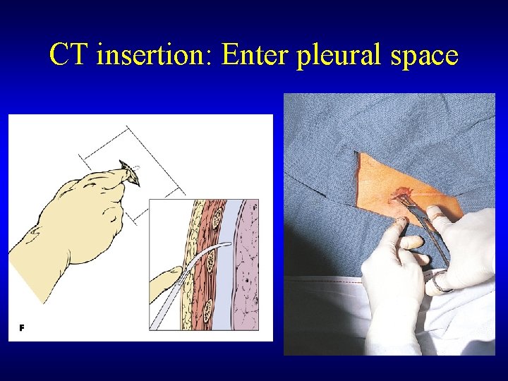CT insertion: Enter pleural space 