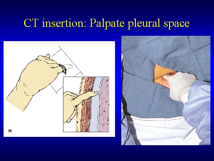 CT insertion: Palpate pleural space 