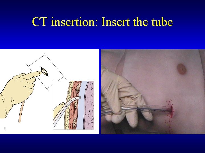 CT insertion: Insert the tube 