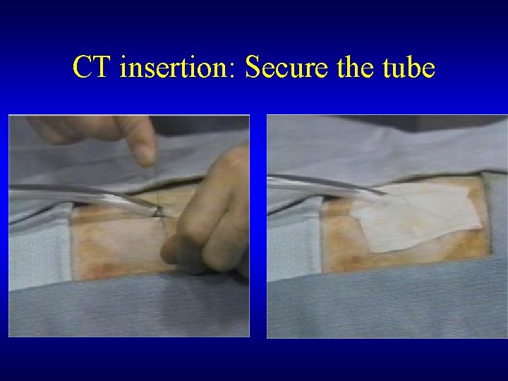 CT insertion: Secure the tube 