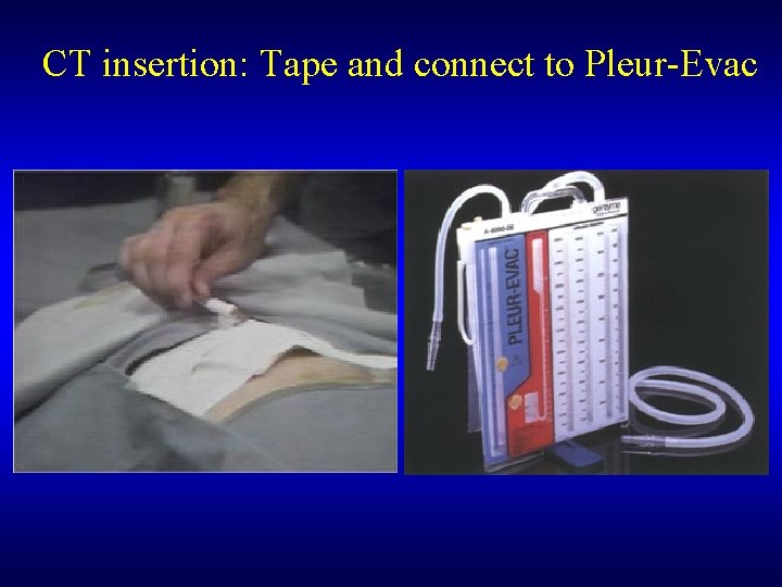 CT insertion: Tape and connect to Pleur-Evac 