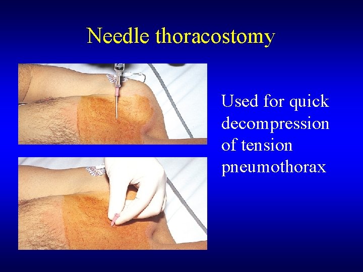 Needle thoracostomy Used for quick decompression of tension pneumothorax 