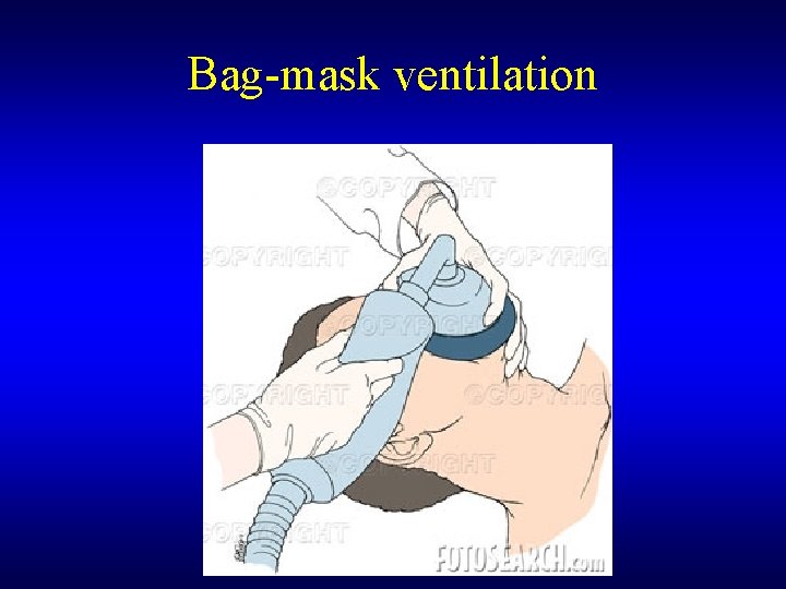 Bag-mask ventilation 