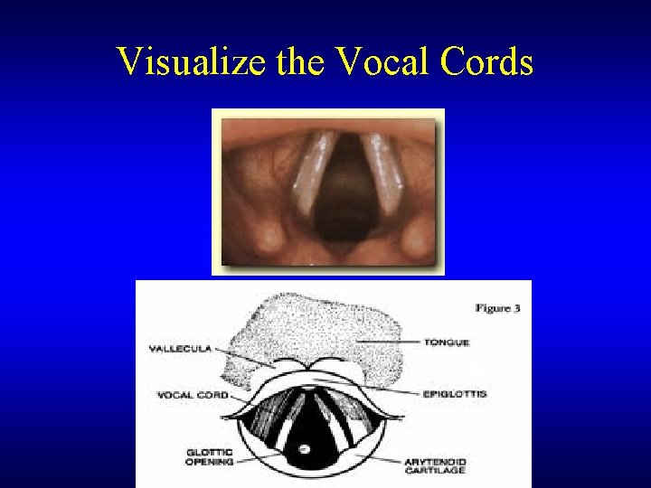 Visualize the Vocal Cords 