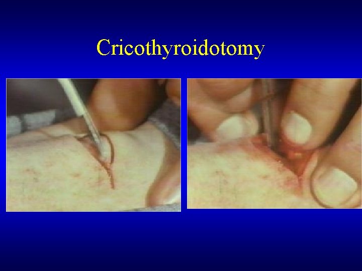 Cricothyroidotomy 