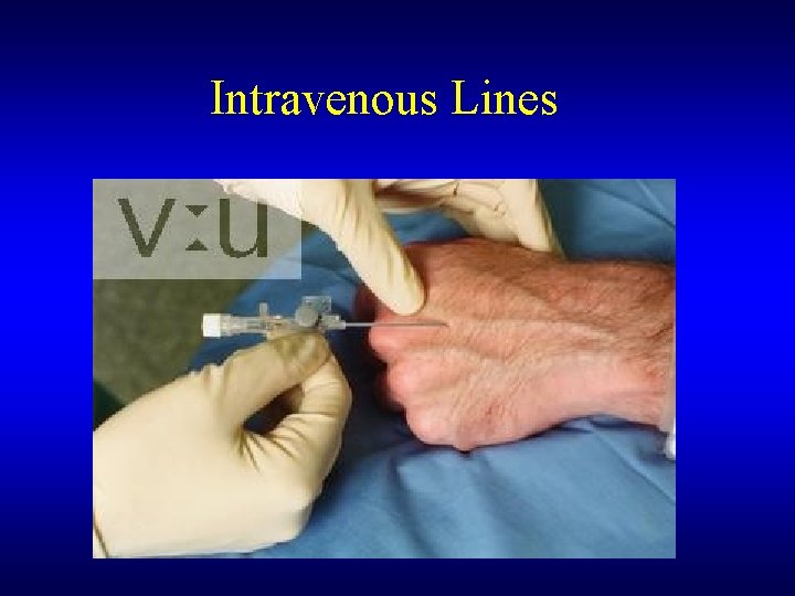 Intravenous Lines 