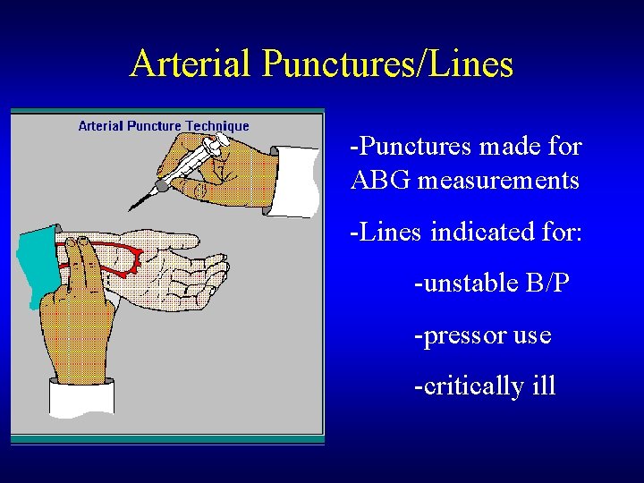 Arterial Punctures/Lines -Punctures made for ABG measurements -Lines indicated for: -unstable B/P -pressor use