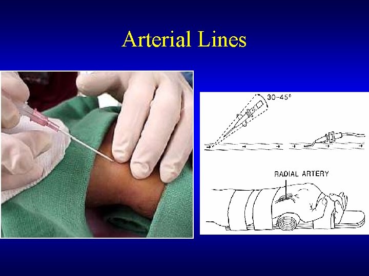 Arterial Lines 